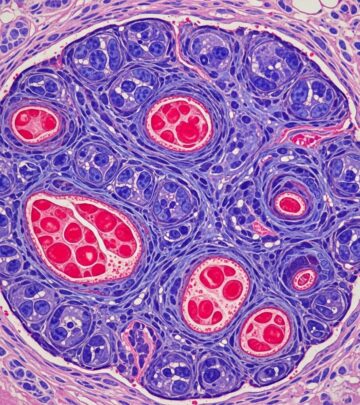 Detailed pathology of acquired elastotic haemangioma, a benign vascular lesion linked to chronic sun exposure in sun-damaged skin.