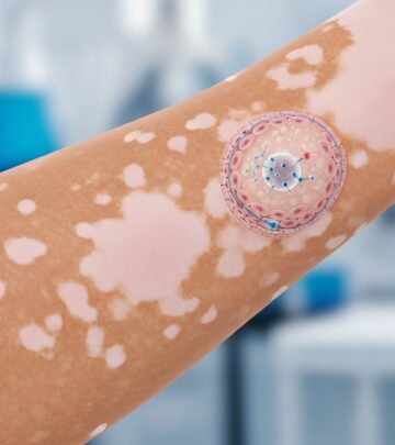 Understanding drug-induced vitiligo: causes, symptoms, diagnosis, management, and prevention strategies for this rare skin condition.