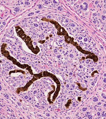 Detailed histopathological analysis of phaeohyphomycosis, a dematiaceous fungal infection affecting skin and deeper tissues.