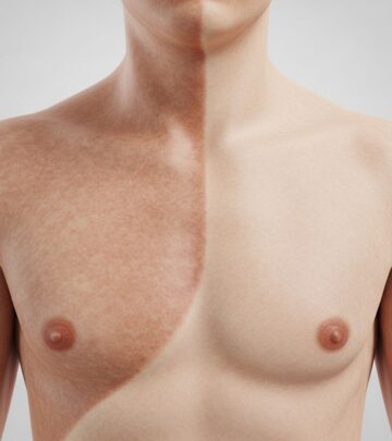 Understanding segmental pigmentation disorder: unilateral hypo- or hyperpigmented patches on the torso without systemic issues.