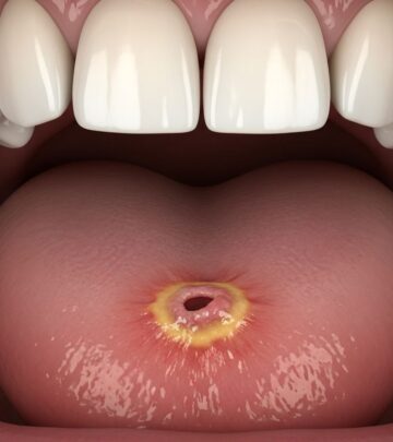 Understanding Riga-Fede disease: causes, symptoms, diagnosis, and effective treatments for this benign oral ulceration in infants.