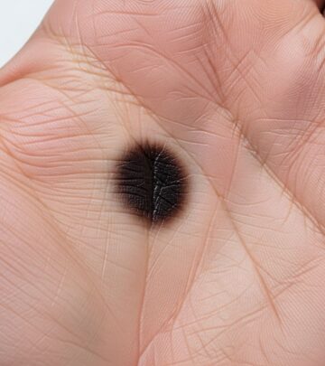 Superficial fungal infection causing dark patches on palms and soles, common in tropical climates.